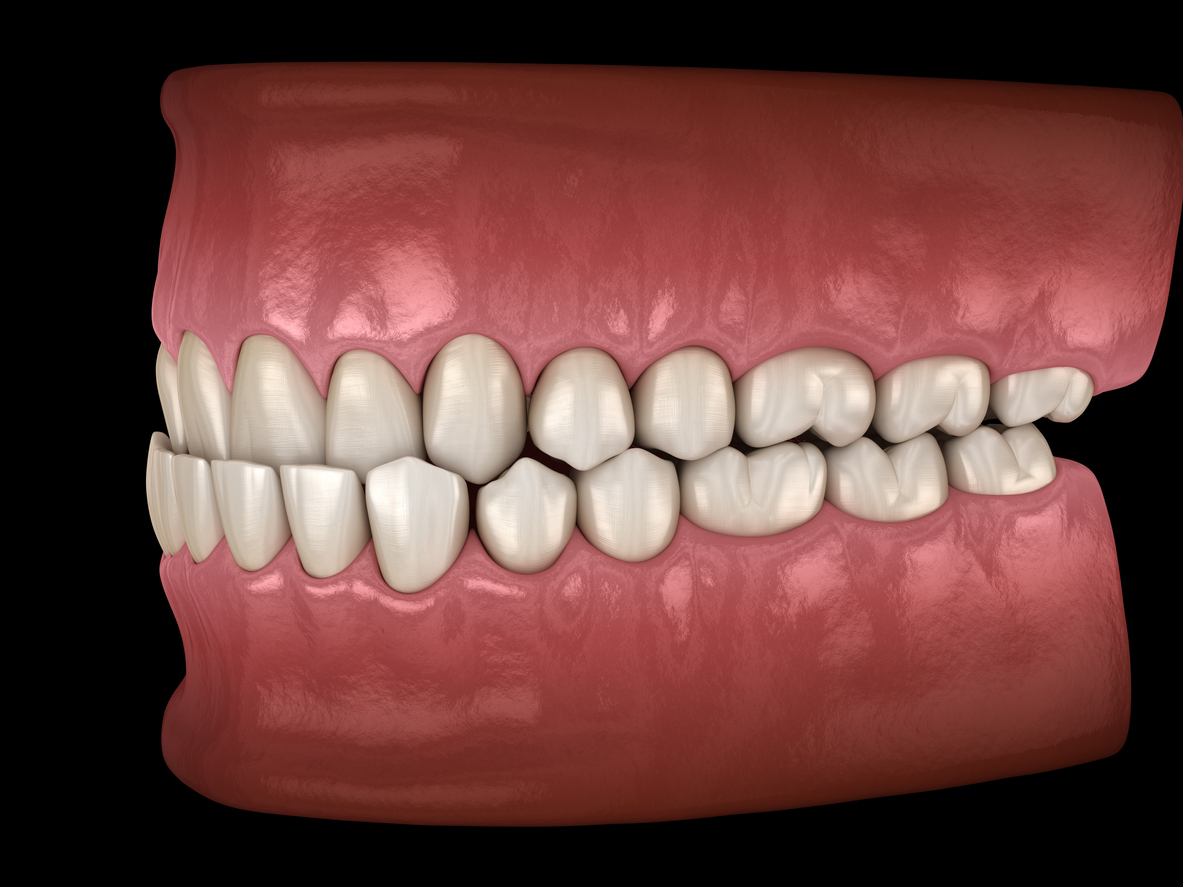Blog  Tompkins Orthodontics